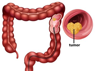 colorectal-cancer-crc-infographic-education_1308-47971 colorectal-cancer-crc-infographic-education_1308-47971